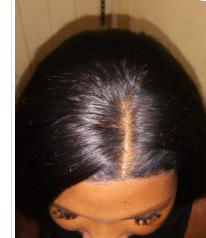 Aplicacao e personalizacao de protese