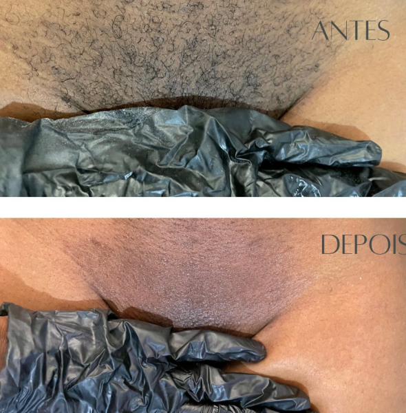 Serviços De Depilação