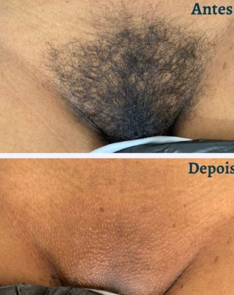 SERVIÇOS DE DEPILAÇÃO