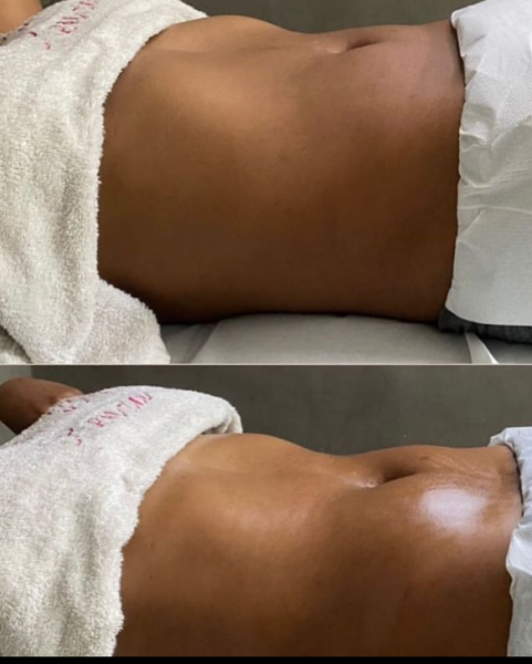 Secções combinas de massagem redução, lipocavitação, lipolaser