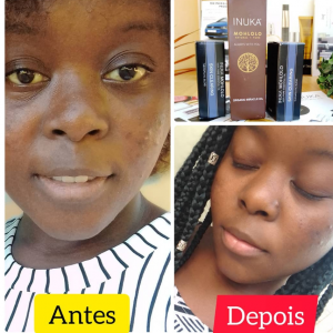 óleos milagrosos Que fazem milagre a pele #oleos para cara #naturecosmeticos #tratamento de acne